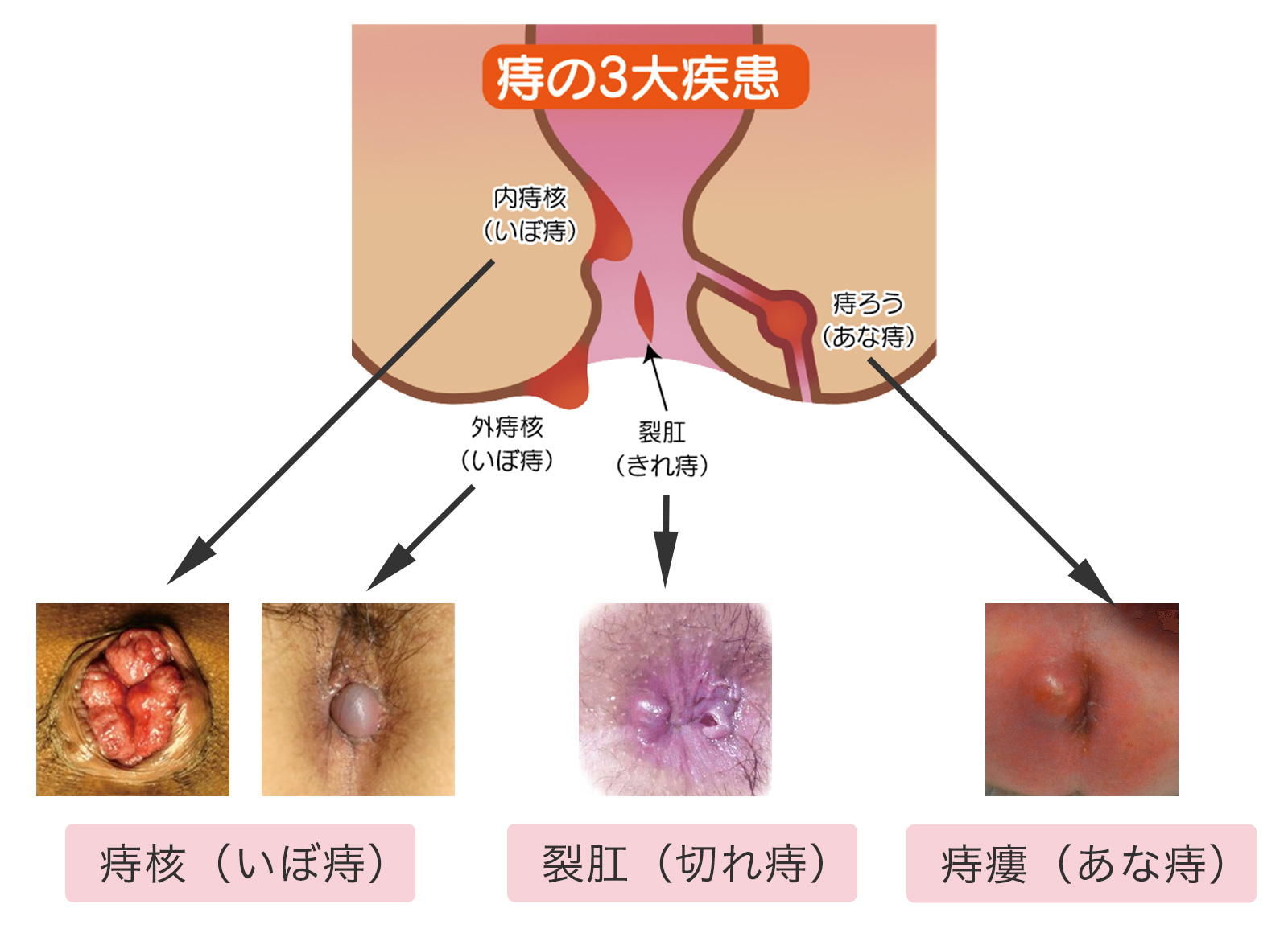 痔の３大疾患　痔核（いぼ痔）・裂肛（切れ痔）・痔瘻（あな痔）